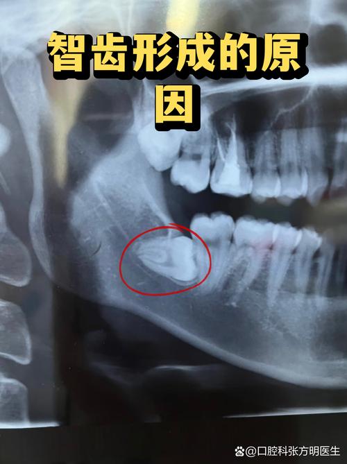 由于現(xiàn)代人頜骨空間不足,很多智齒無法正常生長,導(dǎo)致各種口腔問題